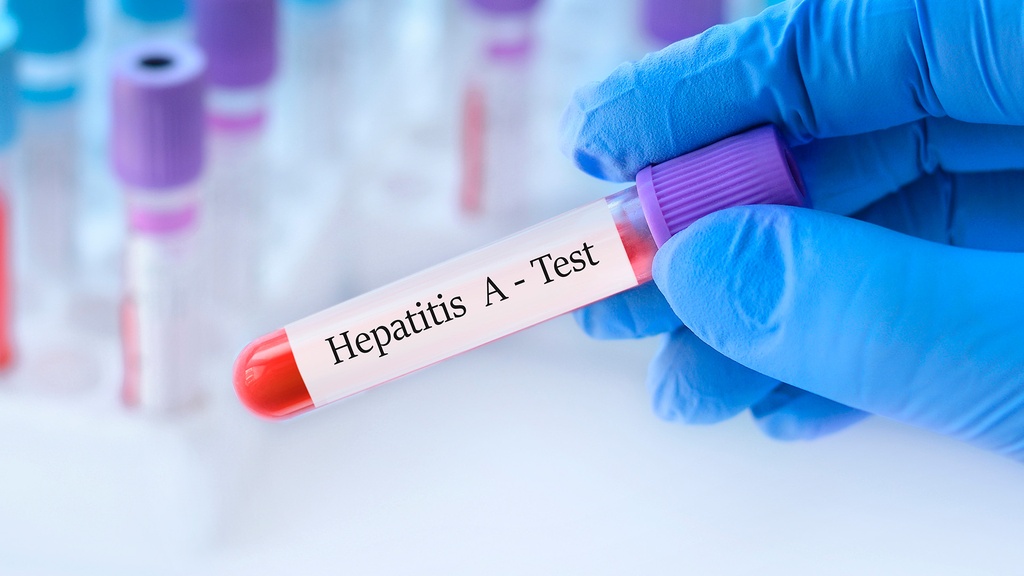 Ac. Anti - Hepatitis A (IgM) | Lapi Laboratorio Médico
